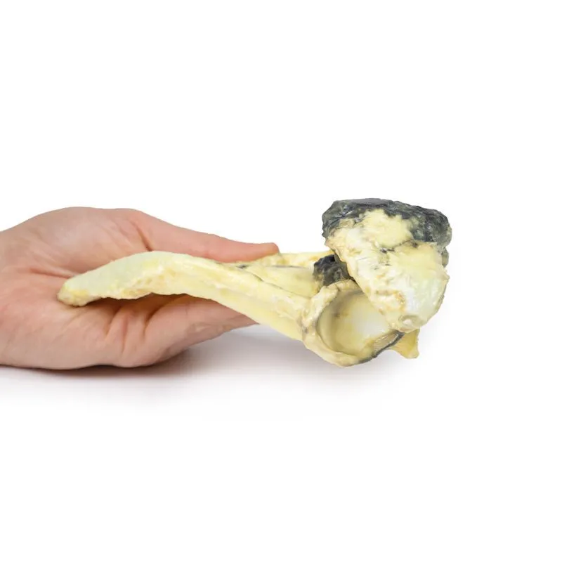 3D Printed Chondrosarcoma of Scapula