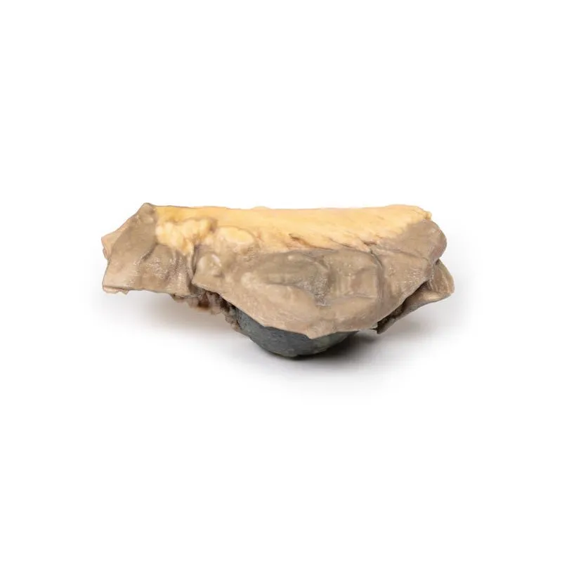 3D Printed Gall Stone Ileus