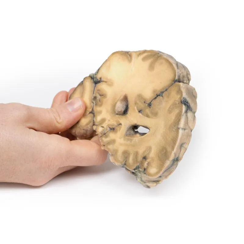 3D Printed Metastatic Adenocarcinoma in the Brain