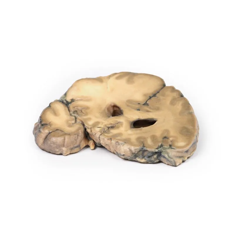 3D Printed Metastatic Adenocarcinoma in the Brain